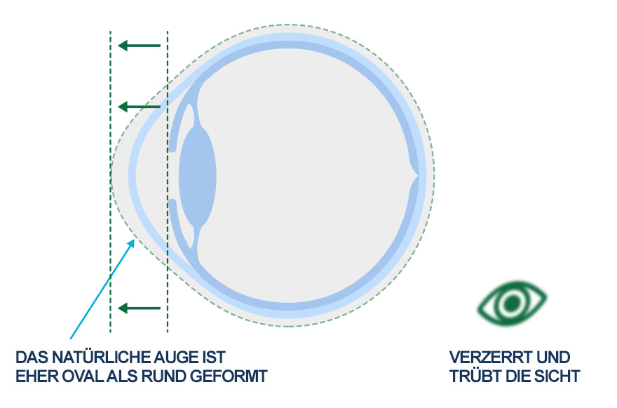 Visual showing eye shape with astigmatism